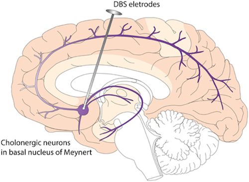 Traditional deep brain stimulation techniques are more invasive than ultrasound therapy. Image: Zhang Q, Kim Y-C and Narayanan NS [CC BY 4.0], via Wikimedia Commons.